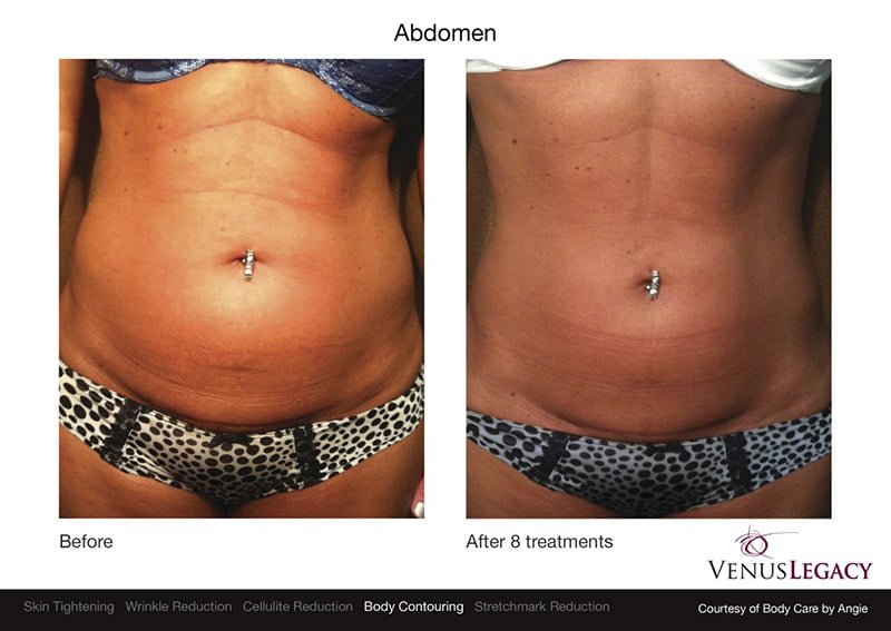 Venus Body Contouring Arlington