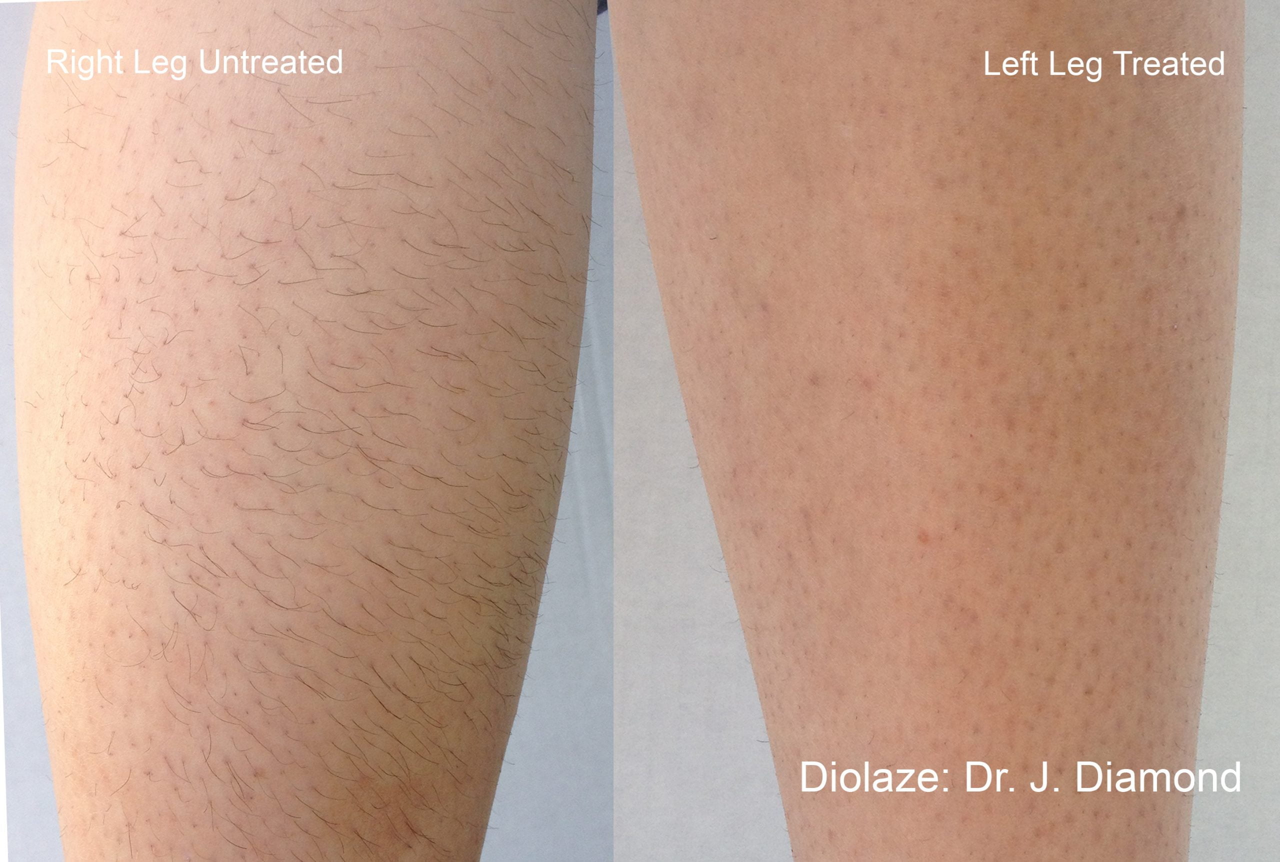 Laser Hair Removal The Gift MedSpa