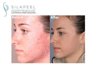 SilkPeel Dermalinfusion Before and After