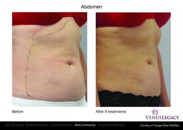 Venus RF Body Contouring  Brockville MediSpa Cosmetic & Skin Clinic